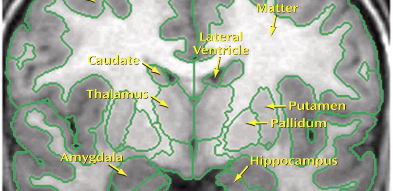 Afname volume thalamus bij patiënten met een motorische conversiestoornis.